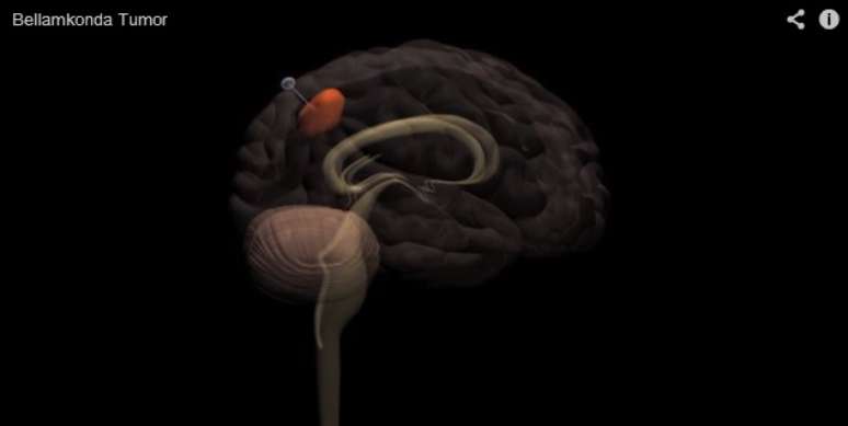 A técnica permite que os pesquisadores movam tumores de locais inoperáveis para áreas mais acessíveis do cérebro