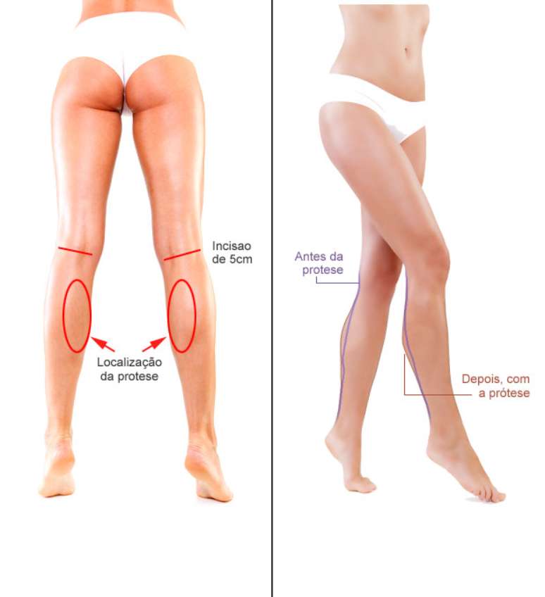 O corte é feito atras do joelho e a prótese é introduzida na região medial da panturrilha