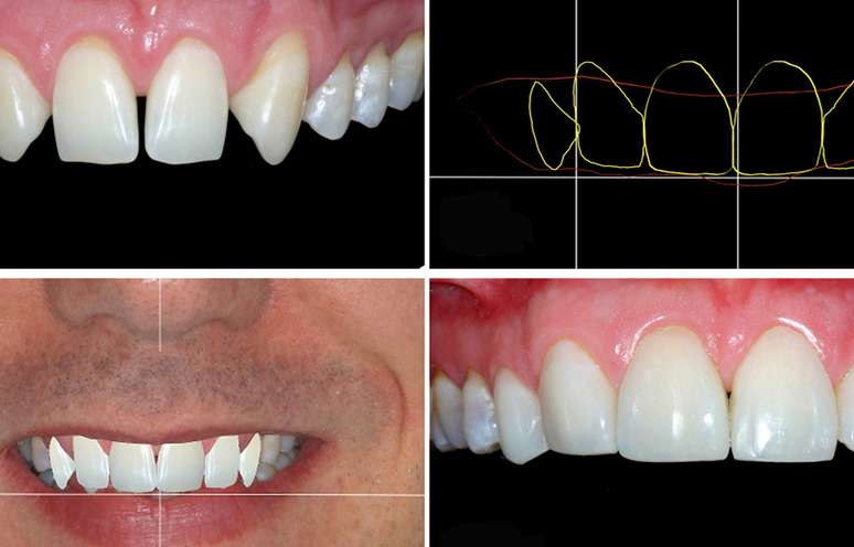 O dentista Cristian Dunker usou o planejamento digital para tratar um paciente que não queria passar por um tratamento com aparelhos ortodônticos ou implantes