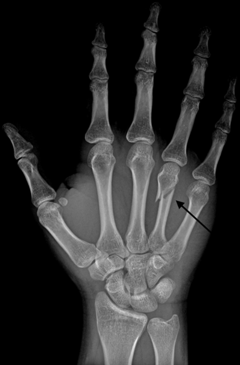 Roy Nelson exibe fratura em raio-x de sua mão