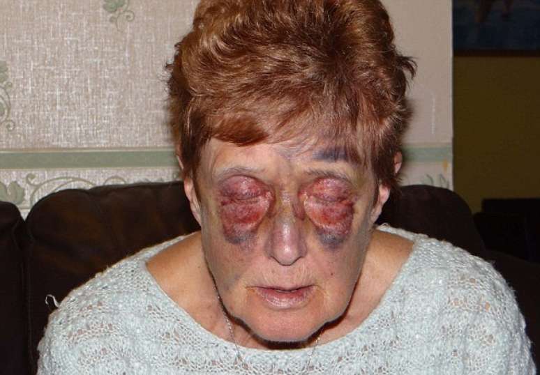 <p>Anne Heenan, de 74 anos, ficou gravemente ferida após tropeçar no meio-fio entre a rua e a calçada no centro de Grimsby, no Reino Unido</p>