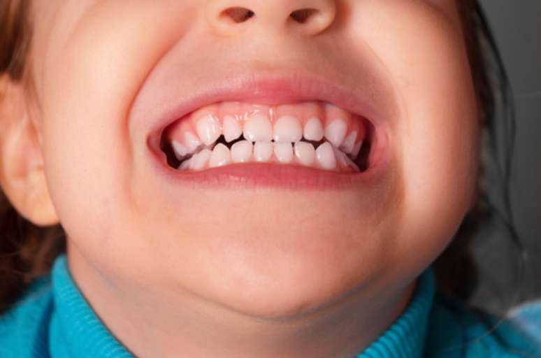 Malformação dos dentes pode estar relacionada com fatores genéticos, hormonais e até ambientais. Porém, independente da causa, deve ser tratada ainda na infância