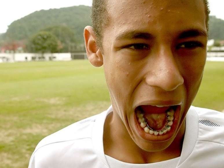 <p>El brasileño Neymar ya utilizó el aparato bucal para arreglar los dientes</p>
