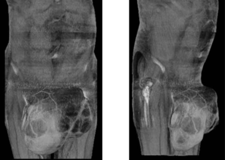 <p>Tumor chegou ao tamanho de uma bola de futebol e foi retirado por meio de cirurgia</p>