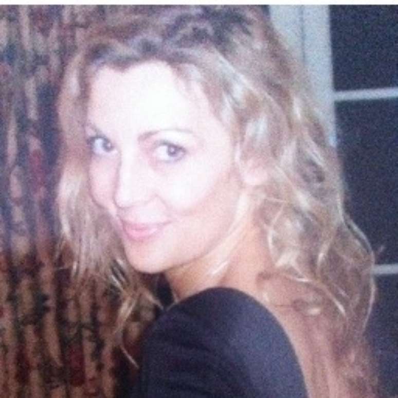 <p>Alice Smellie sofreu de alopecia areata e se assustou ao perder parte dos seus cabelos</p>