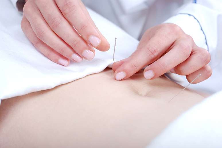 Técnica que consiste na aplicação de pequenas agulhas em pontos definidos do corpo também ajuda a amenizar problemas estéticos comuns, como acne, celulite, flacidez e gordura localizada    