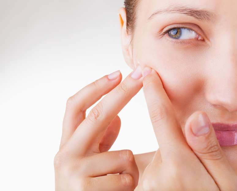 Medicamento isotretinoína derivado da vitamina A facilita o combate à acne severa num período que varia de seis a doze meses