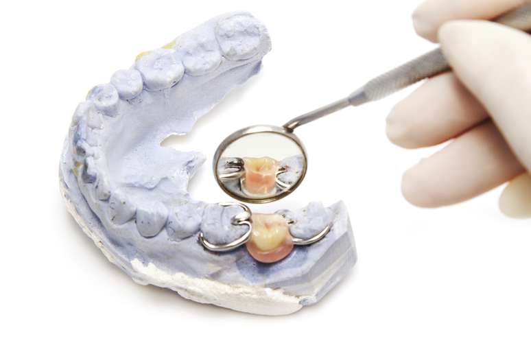 <p>El implante se fusiona con el hueso mandibular, proporcionando un soporte estable para los dientes artificiales</p>