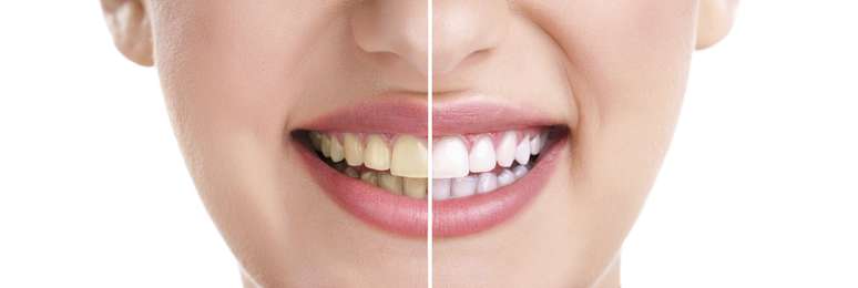 <p> Las cremas dentales blanqueadoras tienen agentes químicos especiales o de pulitura que proporcionan la remoción adicional de las manchas</p>