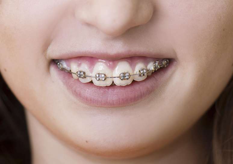<p>Muchos preadolescentes y adolescentes requieren aparatos dentales para corregir dientes apiñados o girados en relación con los arcos dentales</p>