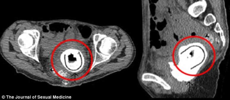 O objeto de 11 cm teria permanecido dentro da vagina da mulher por uma década