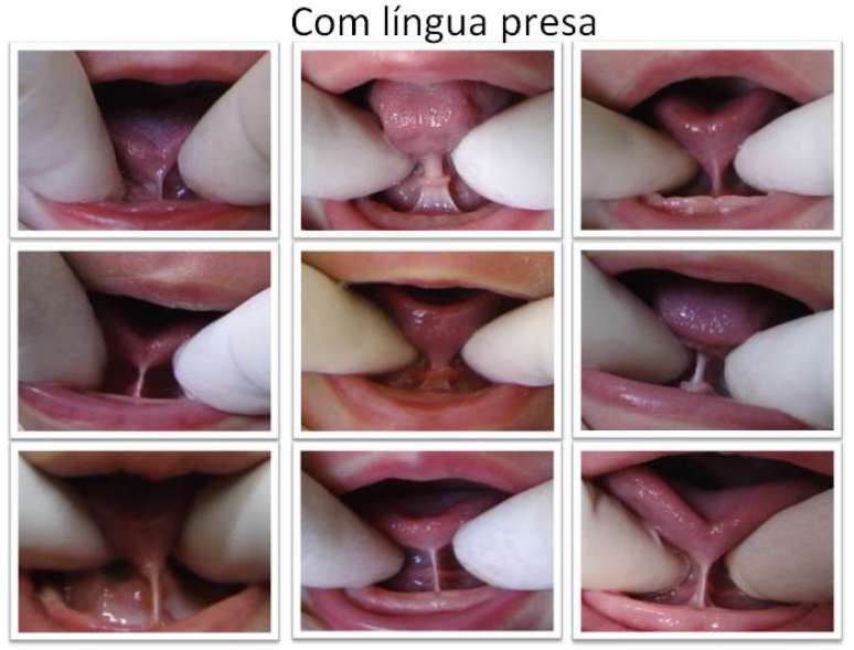 O frênulo é a membrana que liga a língua ao assoalho da boca, popularmente conhecido como freio, e deve estar posicionado no meio da língua