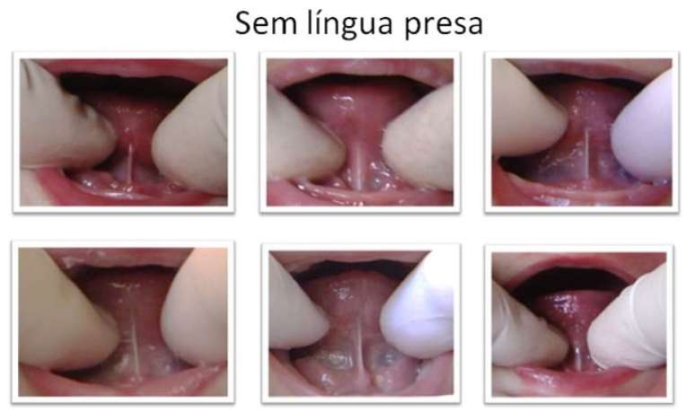 A criança tem língua presa quando o frênulo não está no lugar certo (muito perto da ponta da língua) ou quando ele é muito curto e grosso