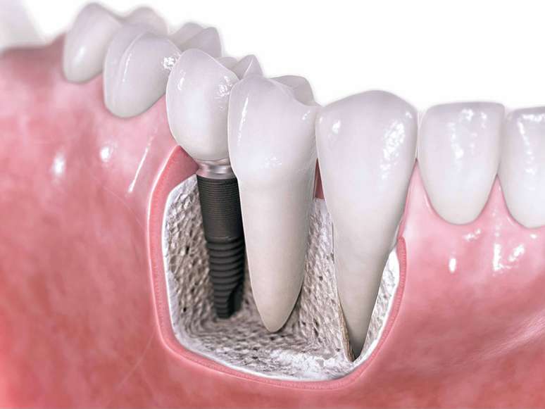 Estudios aseguran que el 98 por ciento de los tratamientos de implantes dentales son bien sucedidos 