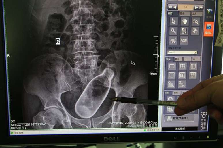 A imagem do raio-X foi divulgada pelos próprios médicos