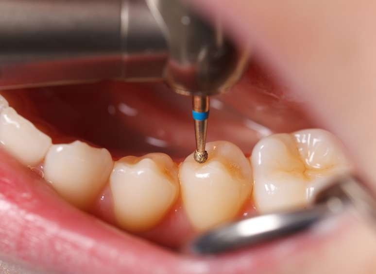 Segundo os pesquisadores, a Remineralização Eletricamente Acelerada e Aumentada é capaz de fortalecer o dente, sem que seja necessária a utilização de brocas