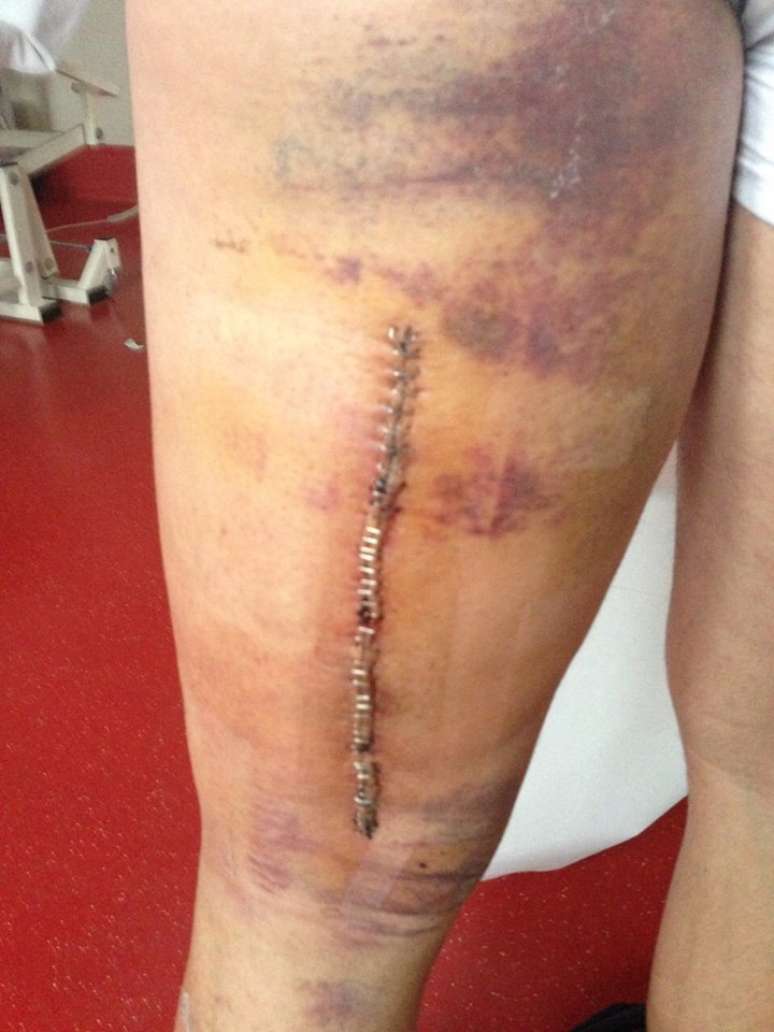 Estrago da les&atilde;o de Simone Pepe, da Juventus