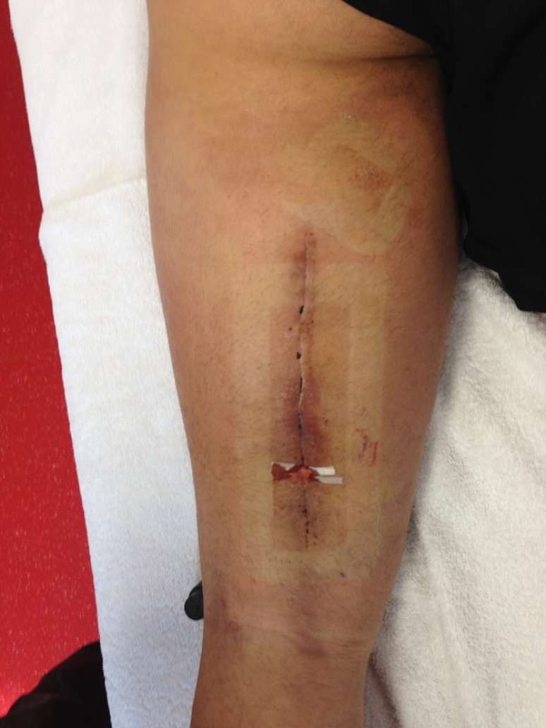 Estrago da les&atilde;o de Simone Pepe, da Juventus