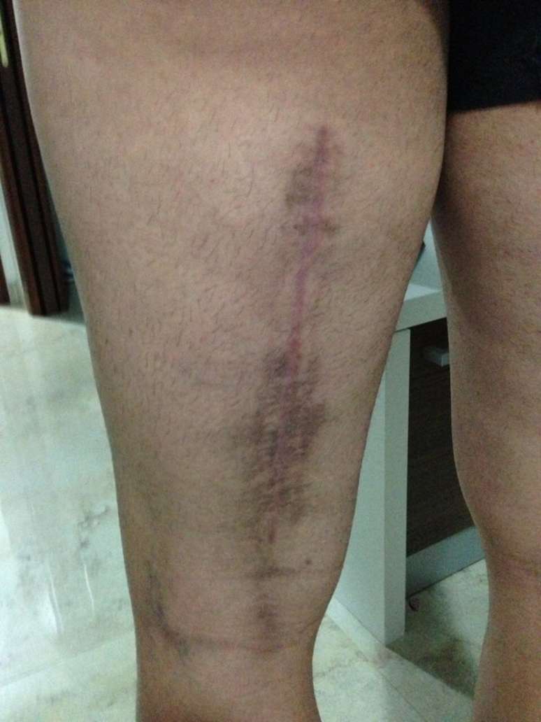 Estrago da les&atilde;o de Simone Pepe, da Juventus