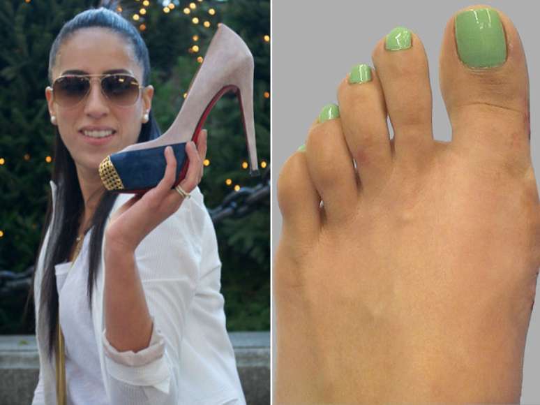 <p>Mulher tira joanetes e muda o formato do p&eacute; com cirurgia</p>