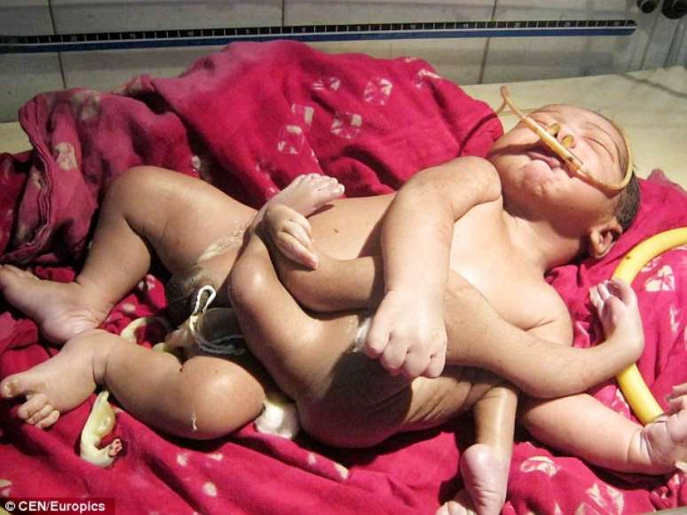 O menino nasceu com 4 pernas e 4 braços por causa de um gêmeo parasita, mas é venerado como um deus