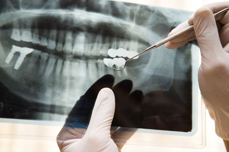 Antes de considerar fazer uma cirurgia de implante, o dentista deve questionar se o paciente está fazendo uso de medicamento para osteoporose