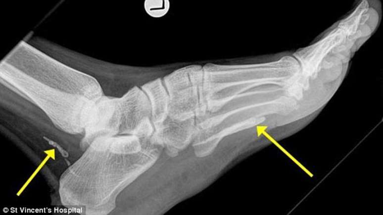 Africano descobre verme de 1 metro dentro de seu p&eacute;