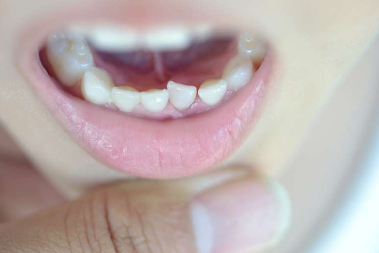 A criança que está na fase de troca de dentes tem ato reflexo suficiente para cuspir o dente e não engolir
