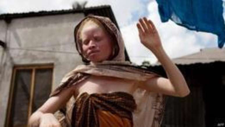 Na Tanzânia, pessoas albinas sofrem sequestros e são até assassinadas por sua condição