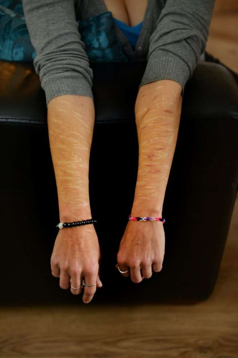 A britânica mostra as cicatrizes feitas pelo ex-namorado