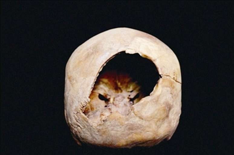 Especialistas garantem que o buraco é relacionado a uma forma primitiva de craniotomia 