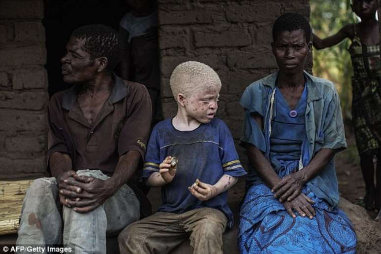 Menino albino senta-se entre seus pais em sua casa em Malawi