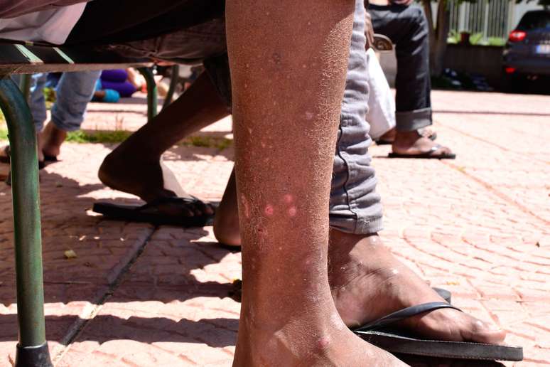 Menor imigrante com a perna tomada pelas feridas da sarna adquirida nos barcos ilegais