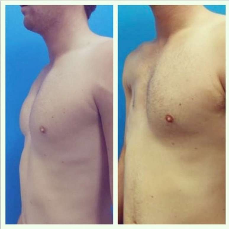 Fotos publicadas no Instagram pelo médico americano Mossi Salibian, que mostram resultado do implante em paciente com síndrome de Poland