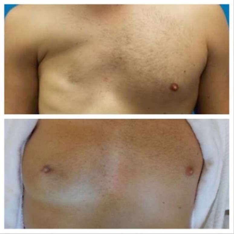 Fotos publicadas no Instagram pelo médico americano Mossi Salibian, que mostram resultado do implante em paciente com síndrome de Poland