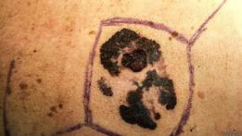 Sinais assimétricos podem ser indício de câncer de pele