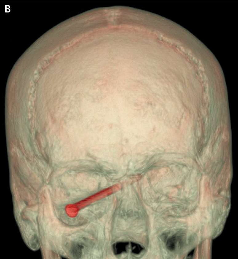 Prego foi removido após cirurgia delicada