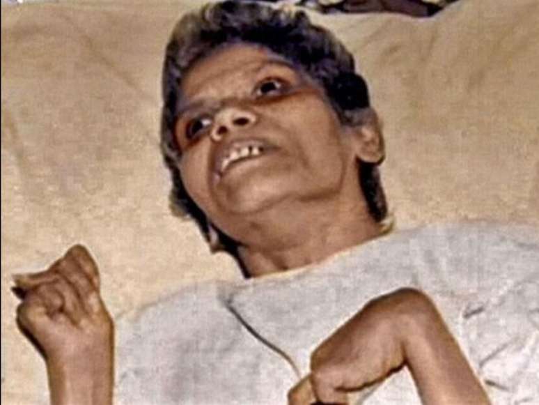 Aruna Shanbaug foi internada em um hospital de Mumbai em 1973 após ter sido vítima de um estupro