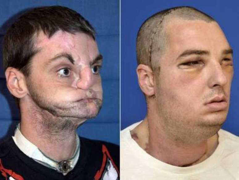 Homem teve o rosto totalmente desfigurado após atirar contra si mesmo acidentalmente