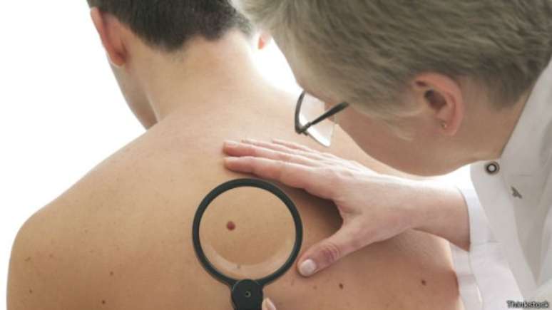 Pesquisa foi feita com 945 pacientes com melanoma avançado