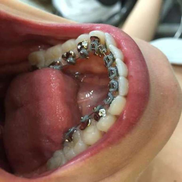 Aparelho lingual invisível trata o dente rápido, mas é caro