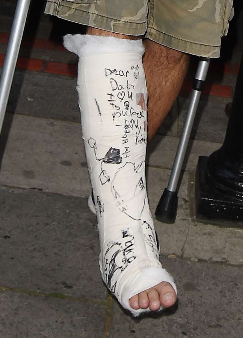 Vocalista do Foo Fighters Dave Grohl com gesso na perna após acidente no palco