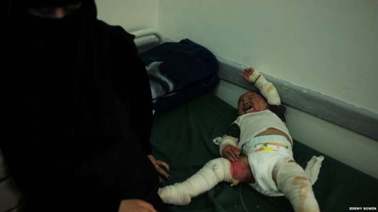 Montaser Mansour, de 2 anos, é acompanhado de sua mãe, Zahour. Ela culpa a Arábia Saudita pelo ataque que também destruiu a casa da família. Os ferimentos graves de Montaser estão sendo tratados, mas o hospital não tem todos os medicamentos que precisa para atender os feridos