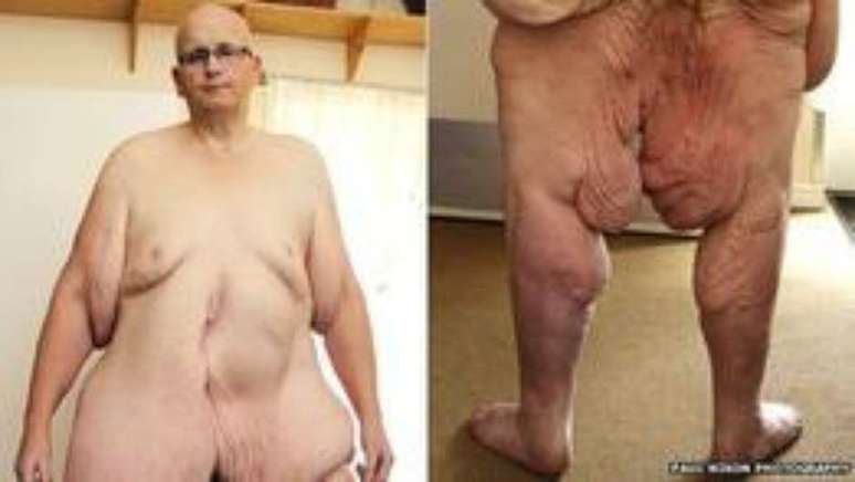 O britânico Paul Mason chegou a ser o homem mais gordo do mundo, perdeu 300 kg com cirurgia e removeu mais de 25 kg só de pele