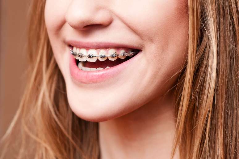 INVISALIGN  Odontologia Sanseverino