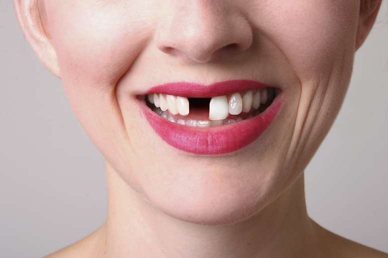 Cuidados importantes com higiene bucal evitam perda dos dentes