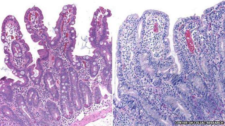 Vilosidades intestinais com aparência normal (esq.) e com as características de um celíaco