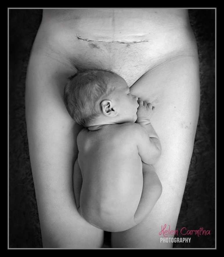 Fotografia de recém-nascido ao lado de cicatriz de cesária causa polêmica na internet