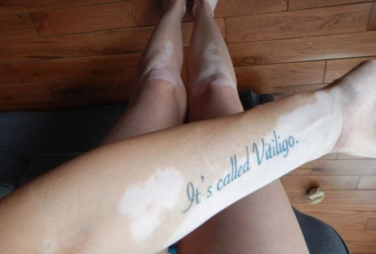 Tiffany Posteraro tatuou o braço com a frase &#034;É chamado de vitiligo&#034; para evitar preconceito 