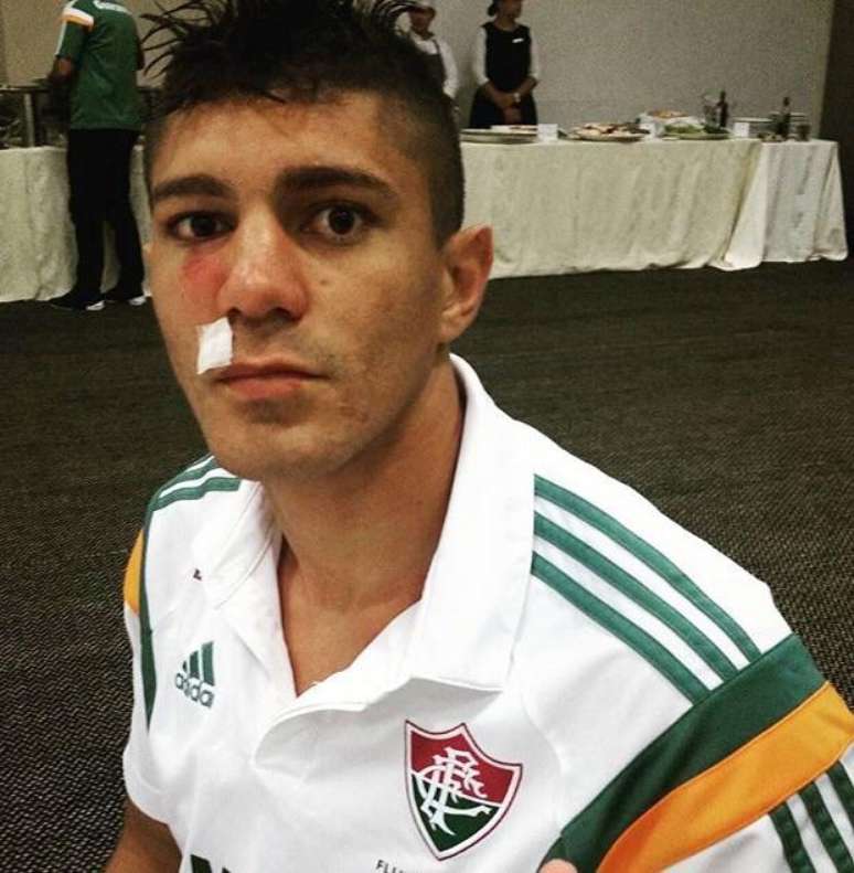 "Se eu tivesse ido para machucar ele, iria falar também, pois sou homem para isso. Mas eu jamais faria isso com um pai de família, colega de trabalho", disse o jogador do Paysandu. Na foto, Edson com o nariz bastante inchado.